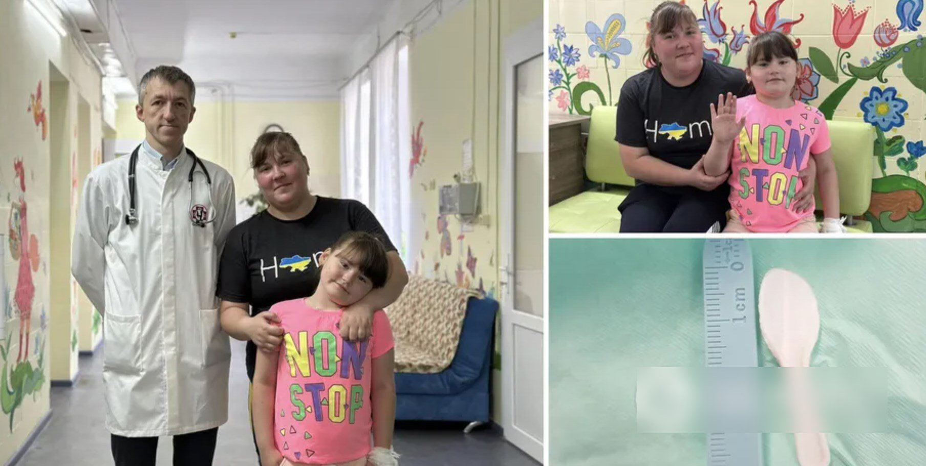 Постійно кашляла та задихалась: українські медики врятували дитину, в дихальних шляхах якої застрягла ложка. Фото Постійно кашляла та задихалась: українські медики врятували дитину, в дихальних шляхах якої застрягла ложка. Фото