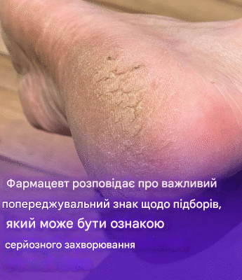 Фармацевт виявив тривожний симптом на п’ятах, який може бути ознакою серйозного захворювання. Фармацевт виявив тривожний симптом на п’ятах, який може бути ознакою серйозного захворювання.