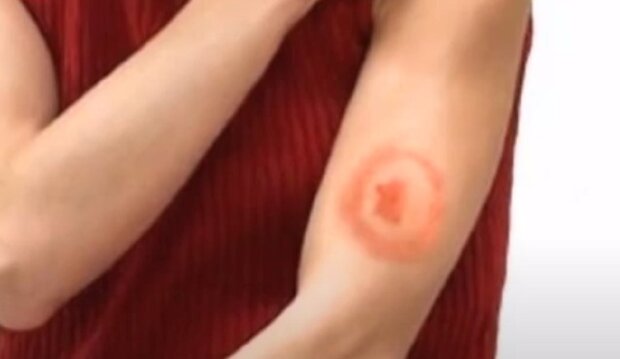 Небезпека від укусу кліща: як розпізнати хворобу Лайма