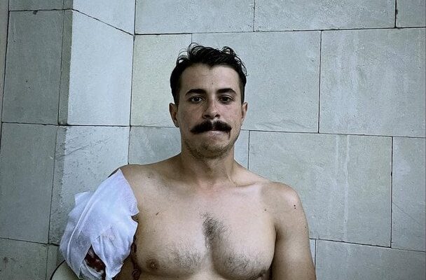 “Багато з вас хоче д0помогти”: Син Костянтина Грубича після ампутації руки вийшов на зв’язок з важливим проханням