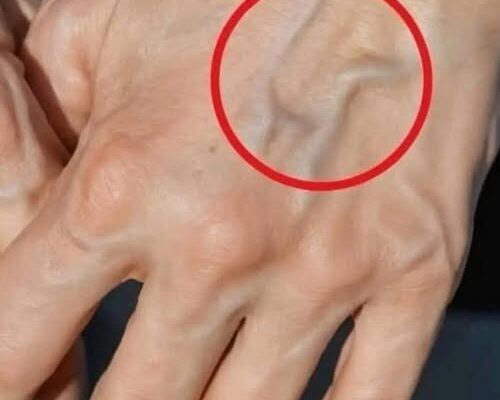 Видимі вени: справжні причини та наслідки для здоров’я