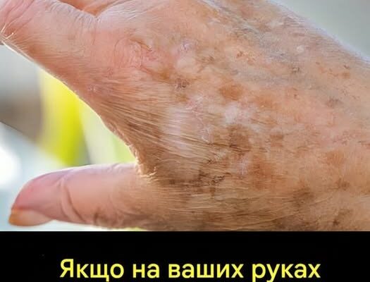 А ви знали, що якщо на руках з’являються схожі плями, то це явна ознака того, що…