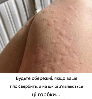 Чому на шкірі з’являється кропив’янка? Ось кілька дивовижних факторів, про які ви можете не знати.