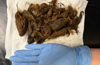 “Синдром Рапунцель”: У Луцьку зі шлунка 7-річної дівчинки витягли майже кілограм волосся (фото)