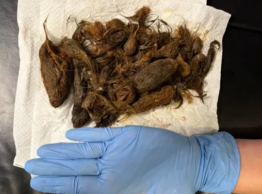 “Синдром Рапунцель”: У Луцьку зі шлунка 7-річної дівчинки витягли майже кілограм волосся (фото)