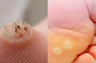 Тривожний знак: цей тип наросту на шкірі може сигналізувати про серйозну проблему