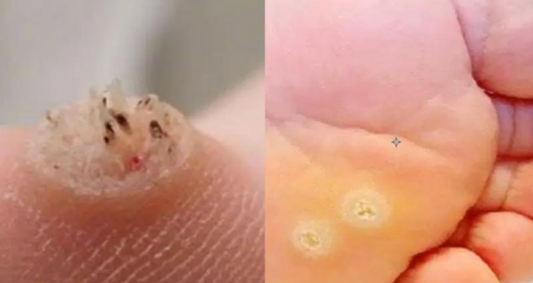 Тривожний знак: цей тип наросту на шкірі може сигналізувати про серйозну проблему