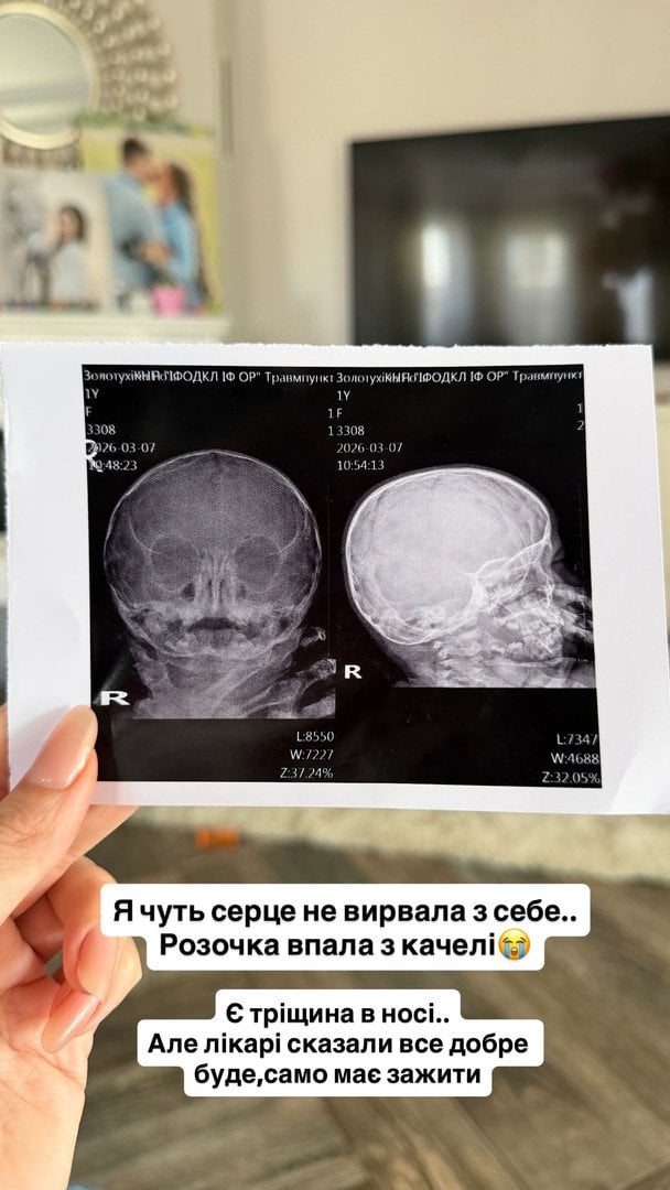 Донька Юлії Верби дістала травму / © instagram.com/verbaaa