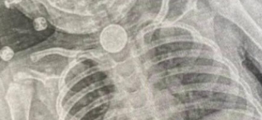 Жила з батарейкою у стравоході: як львівські хірурги врятували 2-річну дівчинку Жила з батарейкою у стравоході: як львівські хірурги врятували 2-річну дівчинку